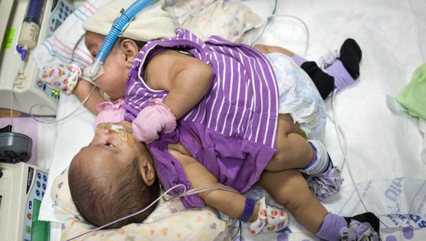 Conjoined Twins Separated After 26 Hour Long Surgery • Utah People S Post